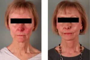 Facelift Before and After Photos