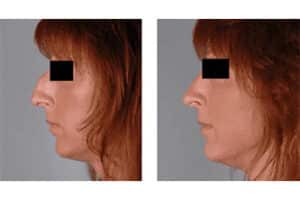 Rhinoplasty Before and After Pictures