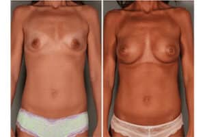 Breast Revision Before and After Photo