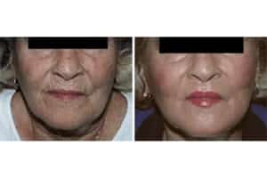 Laser Skin Resurfacing Before and After Photo