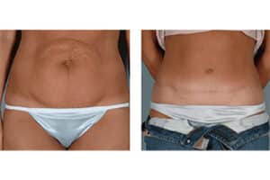 Tummy Tuck Before and After Photos