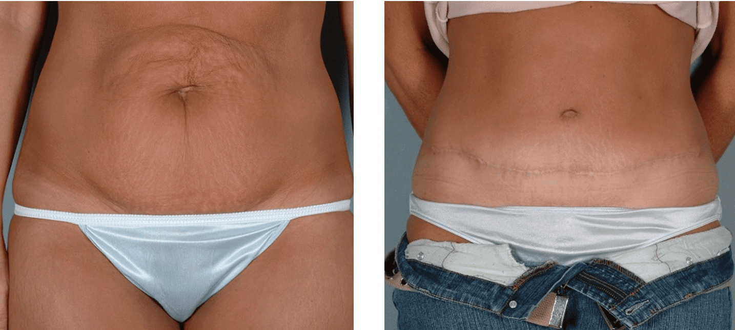 Tummy Tuck (Abdominoplasty) Scar Treatment