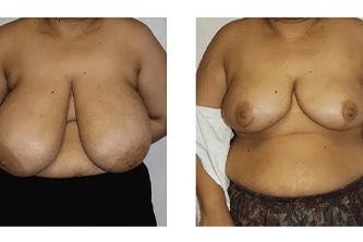 Breast Reduction Before and After Photos