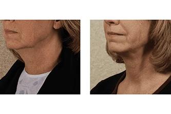 Neck Lift Before and After Photos