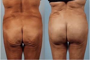 Brazilian Butt Lift Before and After Photo