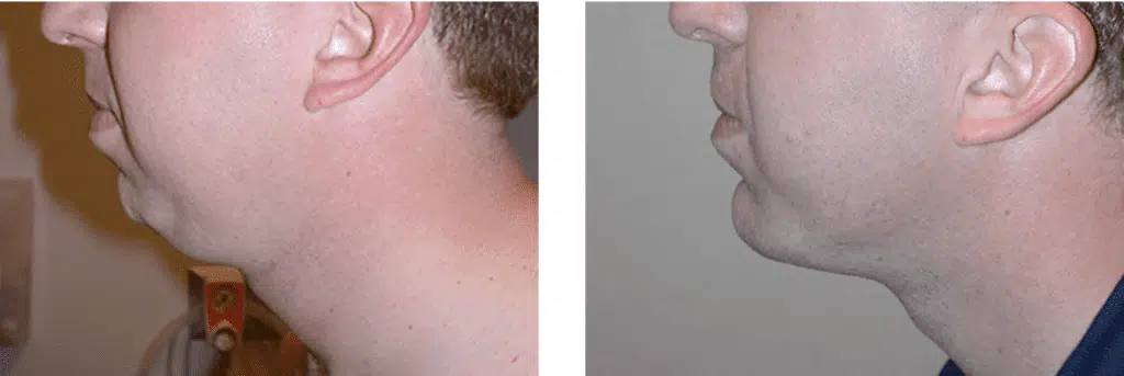 Chin Implant Before and After Photos