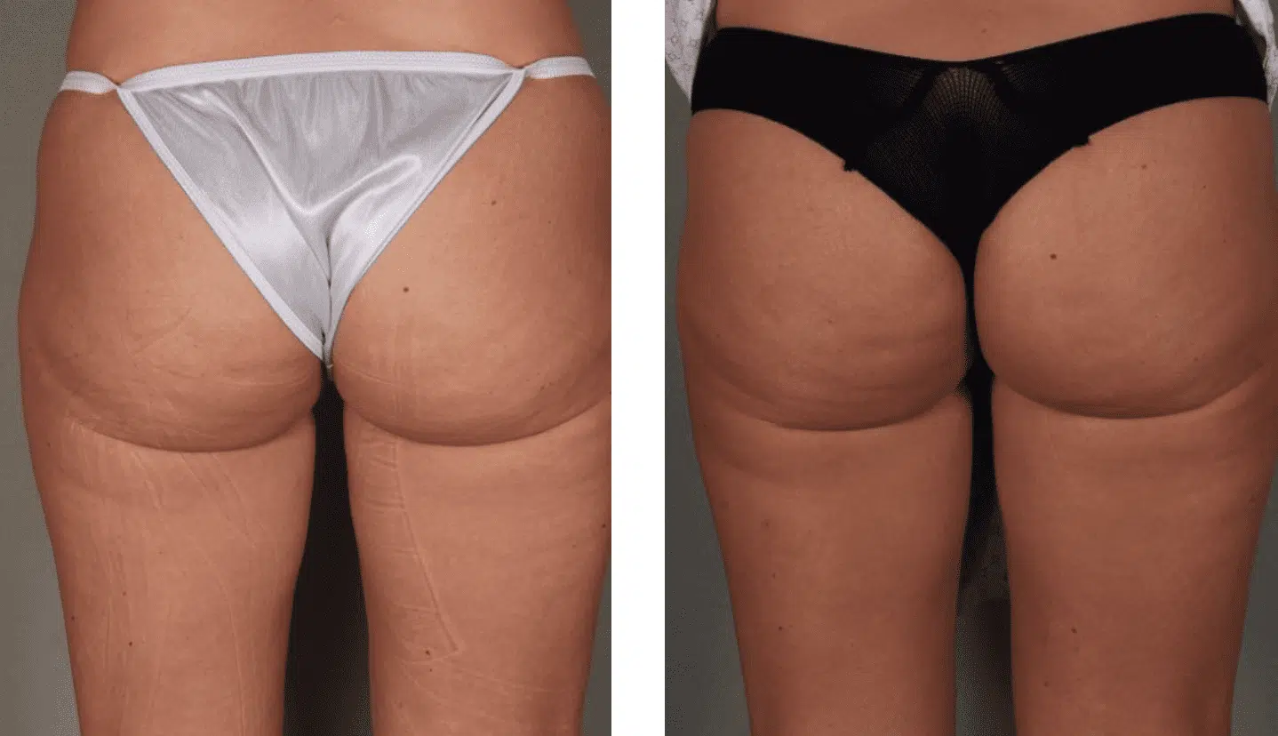 Cellulaze Treatment for Cellulite Before and After Photos