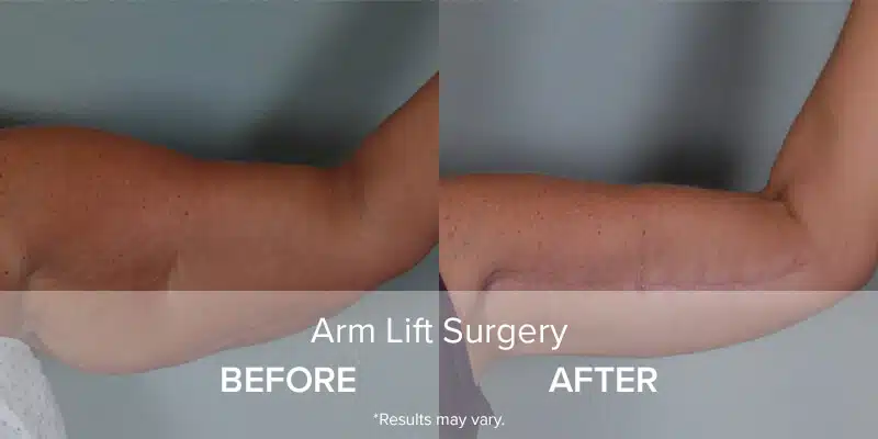 Before and after photos of a patient who underwent arm lift surgery with Dr. Schlechter.