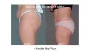 3-B3-Liposuction-abdomen-and-thighs-before--wpcf_500x600-ba-blog-img