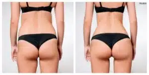 simulated before and after images that show potential results that can be achieved with liposuction-img-blog